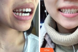 昆明愛雅仕口腔醫(yī)院滕飛整形價格表附牙齒隱形矯正案例展示