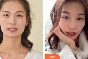 昆明先行口腔門診部楊德龍整形價(jià)格表附牙齒隱形矯正案例展示