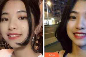 武漢東方麗人醫(yī)院整形美容科陳德權整形價格表附牙齒矯正案例展示