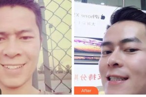 昆明愛雅仕口腔醫(yī)院趙雪菲整形價(jià)格表附金屬托槽矯正案例展示