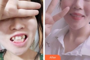 昆明拜博口腔醫(yī)院郝愛(ài)連整形價(jià)格表附自鎖托槽矯正案例展示