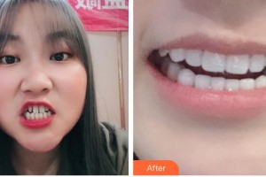 昆明拜博口腔醫(yī)院甘甜整形價(jià)格表附金屬托槽矯正案例展示