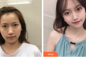 武漢現(xiàn)代女子婦科醫(yī)院整形美容中心黃江泊整形價格表附自體脂肪填充案例展示