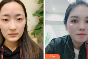 曲靖愛爾眼科醫(yī)院丁云香整形價(jià)格表附切開雙眼皮案例展示