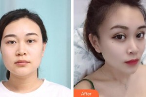 曲靖愛爾眼科醫(yī)院岳煜整形價(jià)格表附眼部綜合案例展示