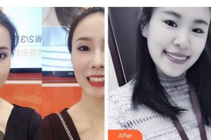 曲靖口腔醫(yī)院聶慶森整形價格表附牙齒隱形矯正案例展示