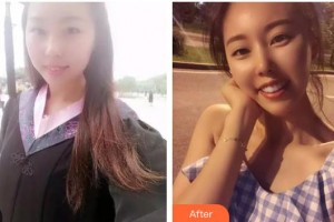 玉溪市人民醫(yī)院皮膚醫(yī)學美容外科李曉東整形價格表附金屬托槽矯正案例展示