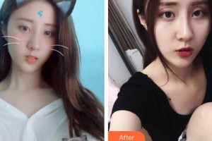 玉溪市人民醫(yī)院皮膚醫(yī)學美容外科矣平整形價格表附激光祛斑案例展示