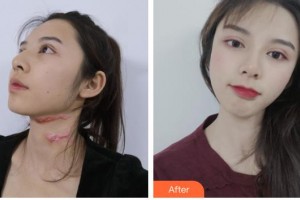 玉溪市人民醫(yī)院皮膚醫(yī)學(xué)美容外科胡瑚整形價(jià)格表附微創(chuàng)疤痕修復(fù)案例展示