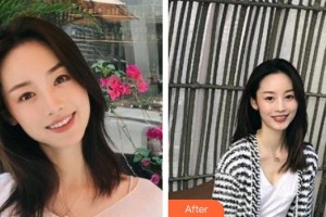 玉溪左醫(yī)生整形美容門診部左玉萍整形價格表附去痘印痘坑案例展示