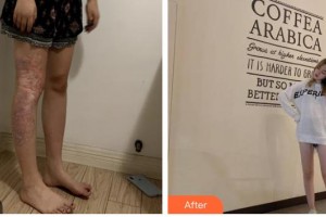 玉溪左醫(yī)生整形美容門診部張文宣整形價(jià)格表附微創(chuàng)疤痕修復(fù)案例展示