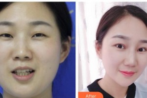 玉溪愛爾眼科醫(yī)院肖莉麗整形價(jià)格表附眼部綜合案例展示