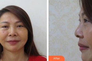 玉溪愛爾眼科醫(yī)院蘇銳整形價(jià)格表附眶隔脂肪釋放案例展示