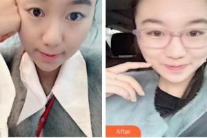 玉溪華山眼科醫(yī)院楊永福整形價(jià)格表附埋線雙眼皮案例展示