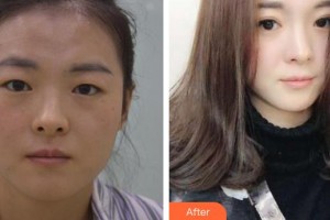 玉溪華山眼科醫(yī)院金發(fā)祥整形價(jià)格表附眼部綜合案例展示