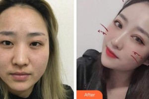 昭通愛麗諾醫(yī)療美容門診部段姍姍整形價格表附切開雙眼皮案例展示