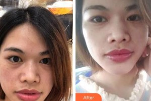 昭通愛麗諾醫(yī)療美容門診部唐文齊整形價(jià)格表附眼部修復(fù)案例展示