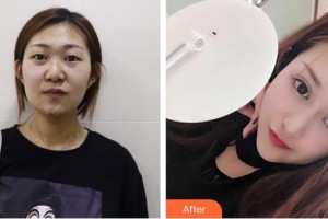 昭通愛麗諾醫(yī)療美容門診部陳志江整形價(jià)格表附切開雙眼皮案例展示