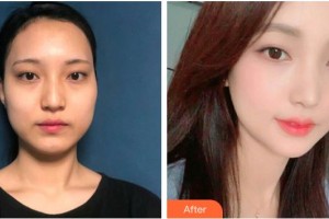 臨滄光明眼科醫(yī)院楊得勝整形價(jià)格表附切開雙眼皮案例展示