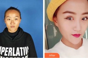 臨滄光明眼科醫(yī)院廖晴國整形價(jià)格表附切開雙眼皮案例展示