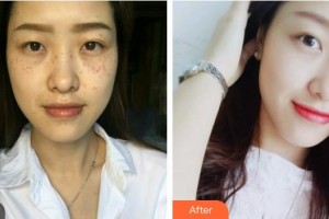 江蘇省人民醫(yī)院整形燒傷科章宏偉整形價(jià)格表附鐳射凈膚案例展示