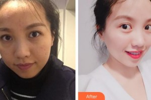 江蘇省蘇北人民醫(yī)院整形美容中心李平松整形價(jià)格表附微針美膚案例展示