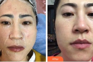 江蘇省人民醫(yī)院整形燒傷科姚剛整形價(jià)格表附白瓷娃娃案例展示