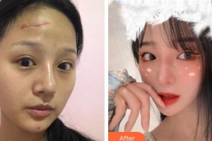 江蘇省人民醫(yī)院整形燒傷科王立夫整形價(jià)格表附激光祛疤案例展示