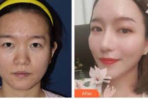 江蘇省人民醫(yī)院整形燒傷科侯祚瓊整形價(jià)格表附鼻部綜合案例展示