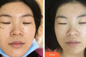 江蘇大學(xué)附屬醫(yī)院燒傷整形外科孫炳偉整形價(jià)格表附激光點(diǎn)痣】案例展示