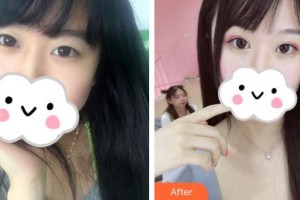 江蘇省人民醫(yī)院整形燒傷科周芳整形價(jià)格表附眼部綜合案例展示