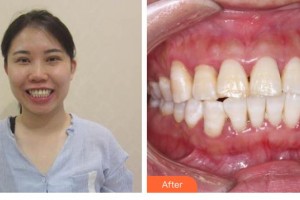 江蘇省口腔醫(yī)院魏昕整形價(jià)格表附牙齒隱形矯正案例展示