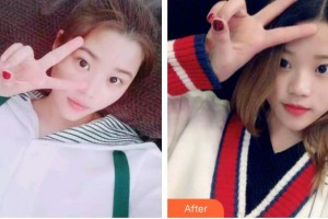 江蘇省人民醫(yī)院整形燒傷科陳默軒整形價(jià)格表附冷光美白案例展示