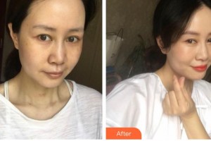 江蘇大學(xué)附屬醫(yī)院燒傷整形外科劉昌整形價(jià)格表附激光祛斑案例展示