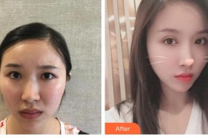 江蘇省第二中醫(yī)院眼科歐陽永斌整形價(jià)格表附眼部綜合案例展示