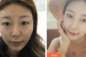 河北現(xiàn)代女子醫(yī)院整形美容中心趙國(guó)輝整形價(jià)格表附切開(kāi)雙眼皮案例展示