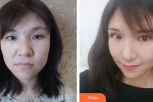 武警河北總隊(duì)醫(yī)院燒傷整形科王淑娟整形價(jià)格表附眼部綜合案例展示