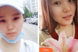 河北醫(yī)科大學(xué)第二醫(yī)院整形美容科張錘整形價(jià)格表附開(kāi)內(nèi)眼角案例展示