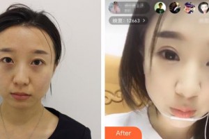 河北工程大學(xué)附屬醫(yī)院整形美容科謝玉娥整形價(jià)格表附切開雙眼皮案例展示