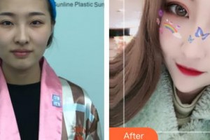 河北醫(yī)科大學(xué)第一醫(yī)院燒傷整形外科張慶富整形價(jià)格表附切開(kāi)雙眼皮案例展示