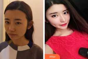 河北省中醫(yī)院醫(yī)療美容科毛俊濤整形價(jià)格表附肋軟骨隆鼻案例展示