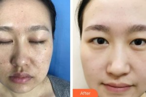 石家莊俏之翼醫(yī)療美容門診部李輝整形價(jià)格表附微針美膚案例展示