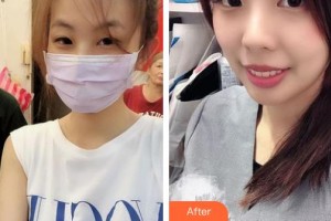 石家莊第一醫(yī)院整形科孫衛(wèi)海整形價(jià)格表附光子嫩膚案例展示