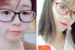 石家莊第一醫(yī)院整形科陳潮整形價(jià)格表附水氧活膚案例展示