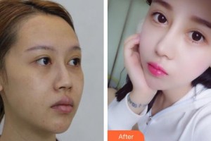 石家莊俏之翼醫(yī)療美容門診部穆寶安整形價(jià)格表附硅膠隆鼻案例展示