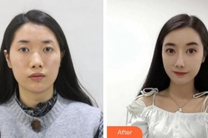 石家莊星源美天醫(yī)療美容醫(yī)院牛曉露整形價(jià)格表附假體隆鼻案例展示