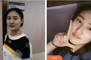 石家莊新興中醫(yī)皮膚病醫(yī)院中醫(yī)美容科楊建國整形價(jià)格表附光子嫩膚案例展示