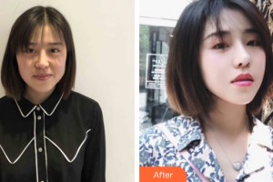 武漢光澤皇后醫(yī)療美容診所洪圣蓉整形價(jià)格表附皮膚美容案例展示