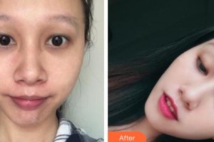 石家莊冀美醫(yī)療美容門診部鄭鳳蘭整形價格表附清潔祛痘案例展示