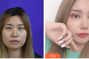 石家莊冀美醫(yī)療美容門診部李芷煥整形價(jià)格表附硅膠隆鼻案例展示